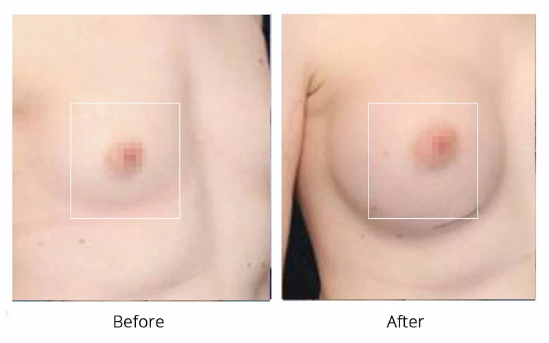 vacuum breast enlargement